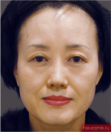 Результаты Нейрамис до процедуры женщина 52 года возраст зона филлера нос лоб носогубная складка скулы