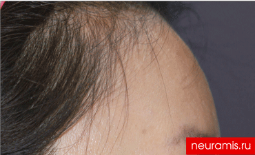 Отзывы Нейрамис после процедуры женщина 43 года возраст зона филлера лоб